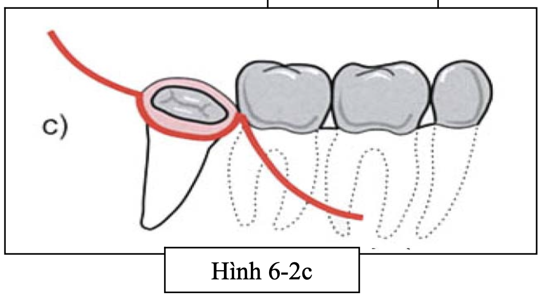 Quy trình phẫu thuật răng khôn: những nguyên tắc cơ bản